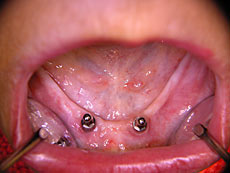 Kugelkopf-Implantate Bild 1 Kugelkopf-Implantate Bild 1