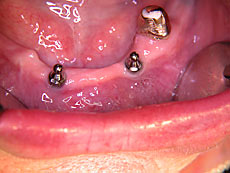 Kugelkopf-Implantate Bild 2 Kugelkopf-Implantate Bild 2