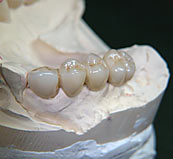 Neu gefertigte Kronen